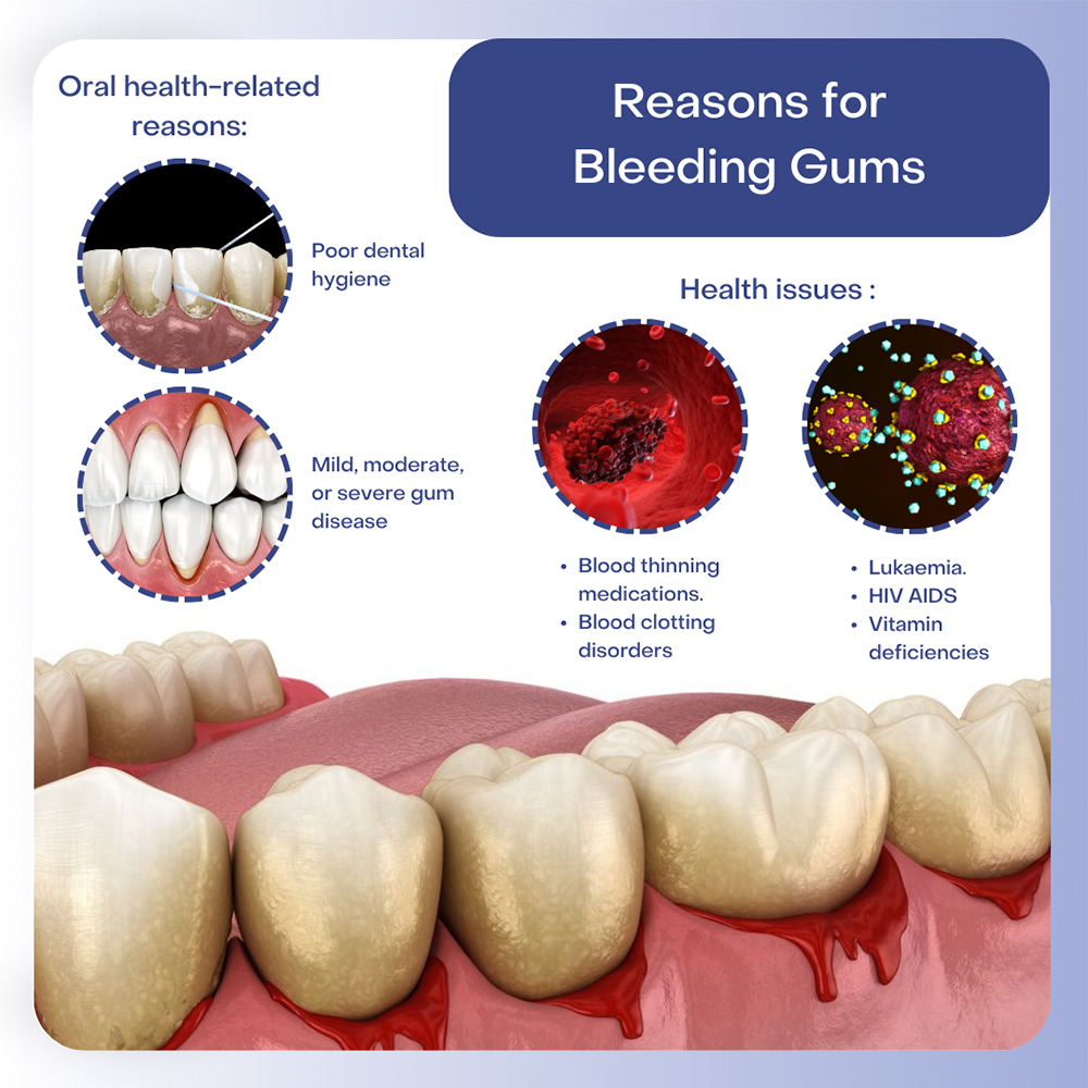 Bleeding Gums Treatment East Bronx, NY