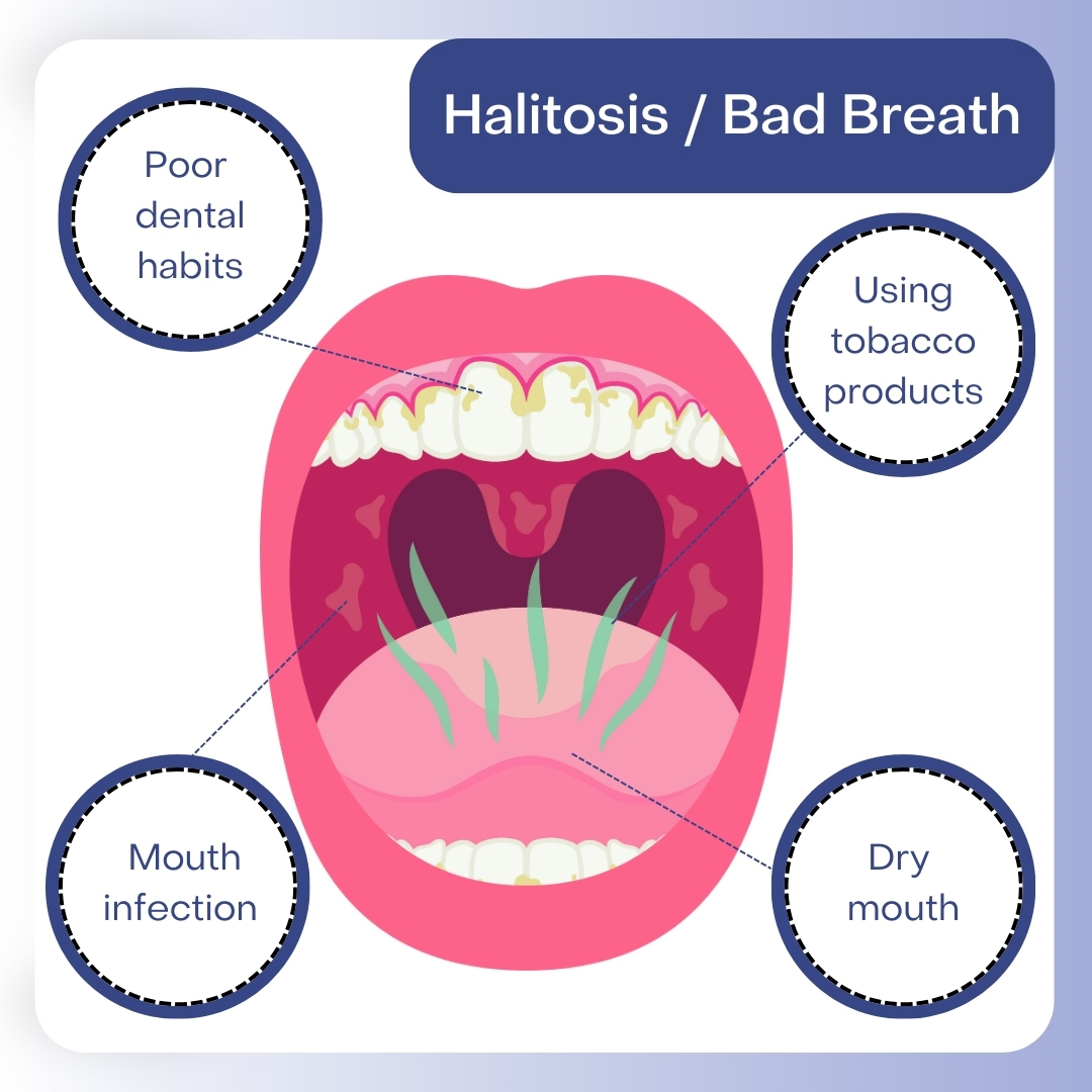 Bad Breath Halitosis Treatment East Bronx Ny